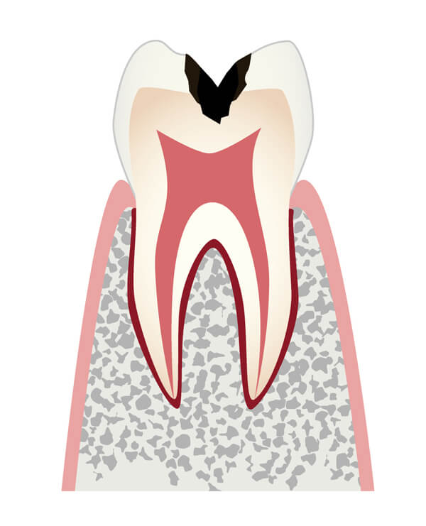 歯の内部（象牙質）まで進行したむし歯